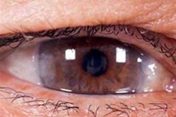 علت برق زدن چشم بعد از عمل آب مروارید