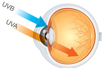 بیماری های چشمی ایجاد شده توسط اشعه uv
