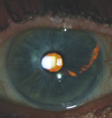 التهاب رنگدانه ای چشم