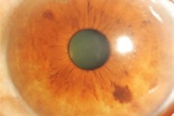  عمل لیزر تنگی زاویه چشم        