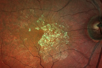 چروکیدگی ماکولا