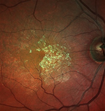 چروکیدگی ماکولا