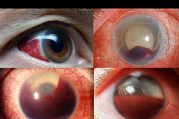 هايفما Hyphema