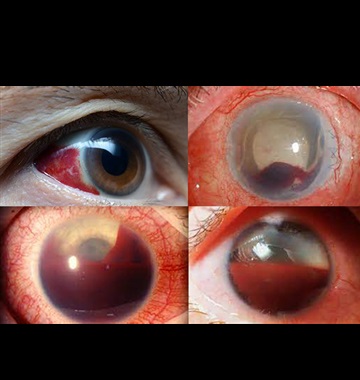 هايفما Hyphema