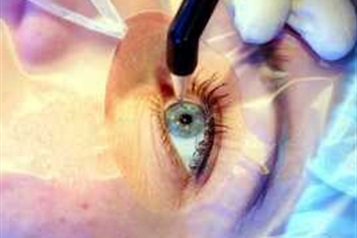 انواع روش های جراحی عیوب انکساری و بررسی مزایا و معایب هر کدام