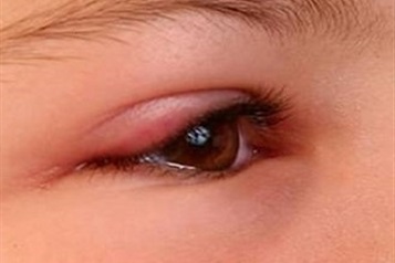 عفونت چشم چیست؟ علائم، دلایل و درمان عفونت چشم