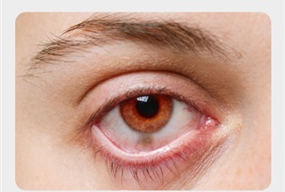 تومور لیپودرموئید چشم چیست و چگونه درمان می شود؟