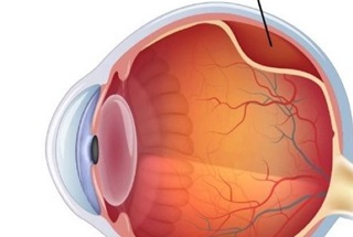 جداشدگی (پارگی) پرده شبکیه