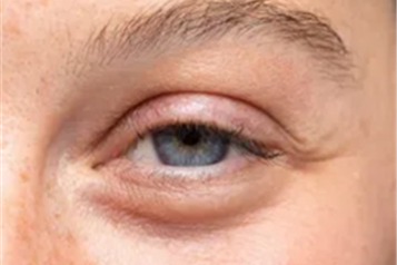 علت کوچک شدن یک چشم نسبت به دیگری چیست؟