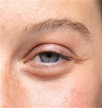 علت کوچک شدن یک چشم نسبت به دیگری چیست؟