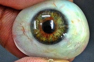 جراحی کاشت عنبیه مصنوعی