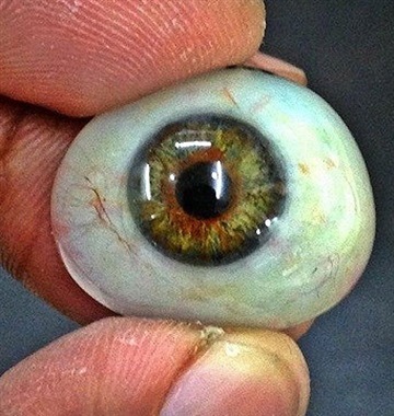 جراحی کاشت عنبیه مصنوعی