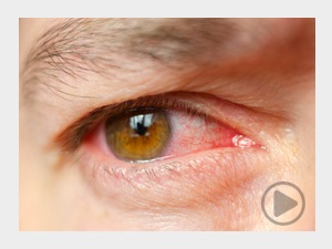 کاشت Glaucoma-istent درمان گلوکوم یا آب سیاه