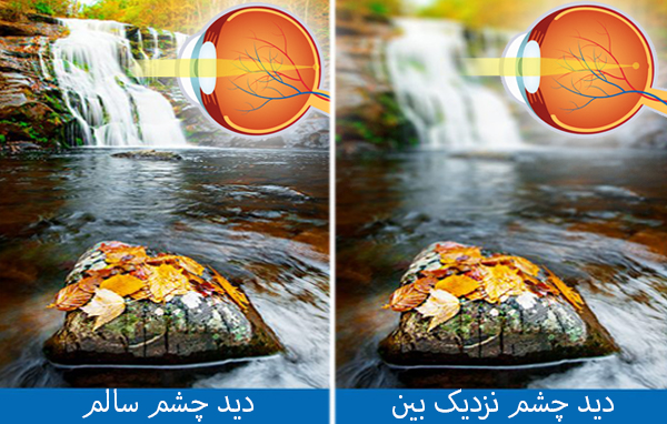 نزدیک بینی چشمی (Myopia)