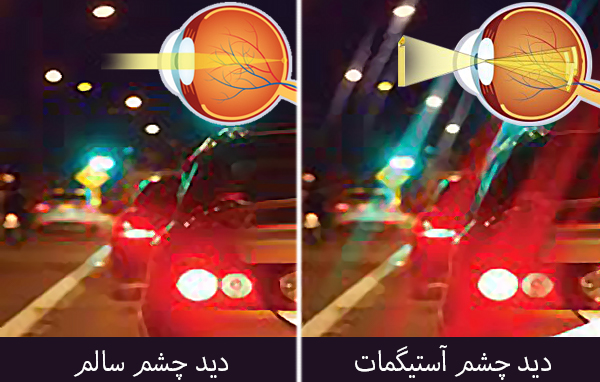 آستیگماتیسم  (Astigmatism)