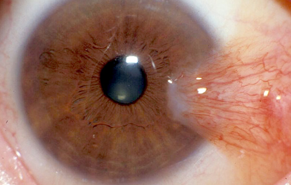 ناخنک چشم (Pterygium)