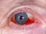 خونریزی زیر ملتحمه (Subconjunctival Hemorrhage)