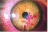 عفونت تبخال چشمی Herpes Simplex